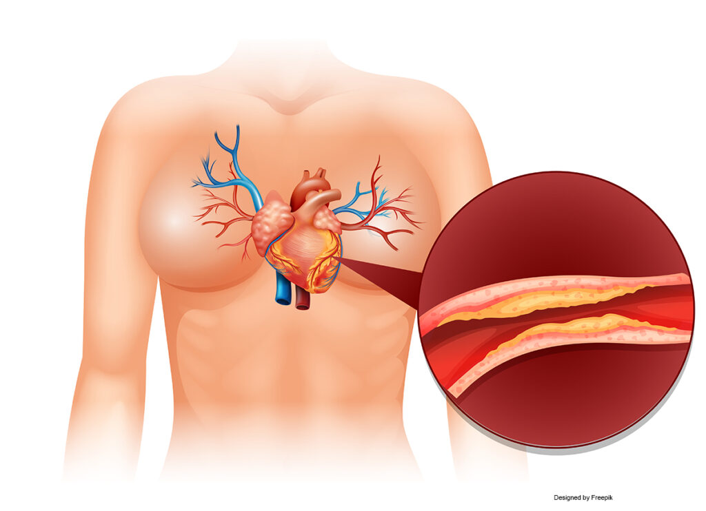 Heart Cholesteral in human illustration